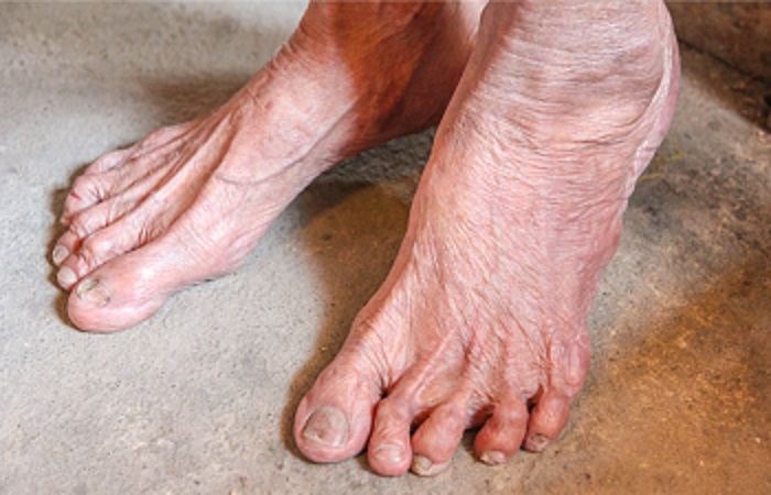 foot problems in elderly loved ones