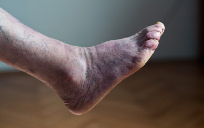 Poor Circulation in the Elderly: Essential Tips to Help