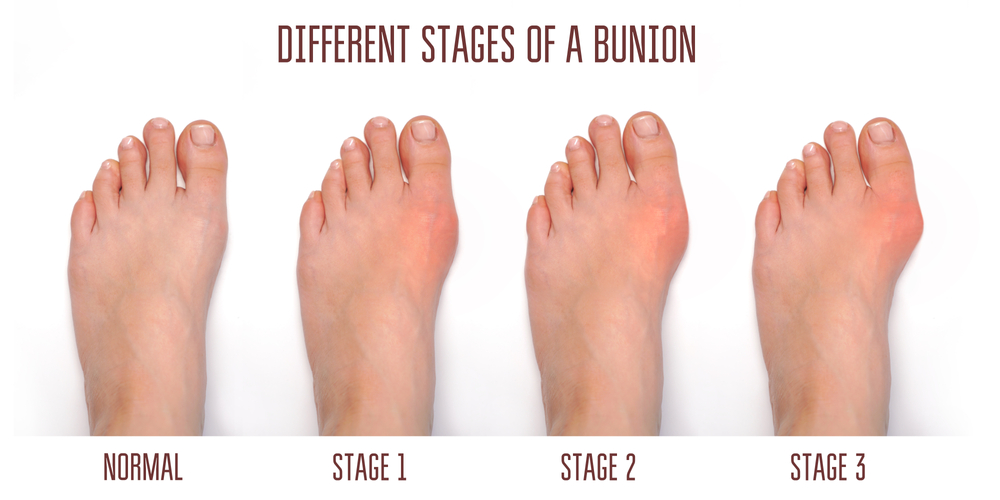 Common Foot Problems in Elderly