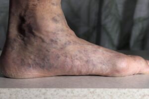 Common Foot Problems in Elderly