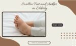 Swollen Feet and Ankles in Elderly