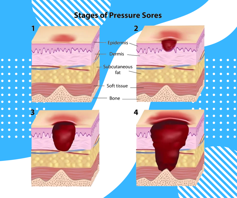 Elderly Pressure Sores: Prevention and Treatment - SR Parents