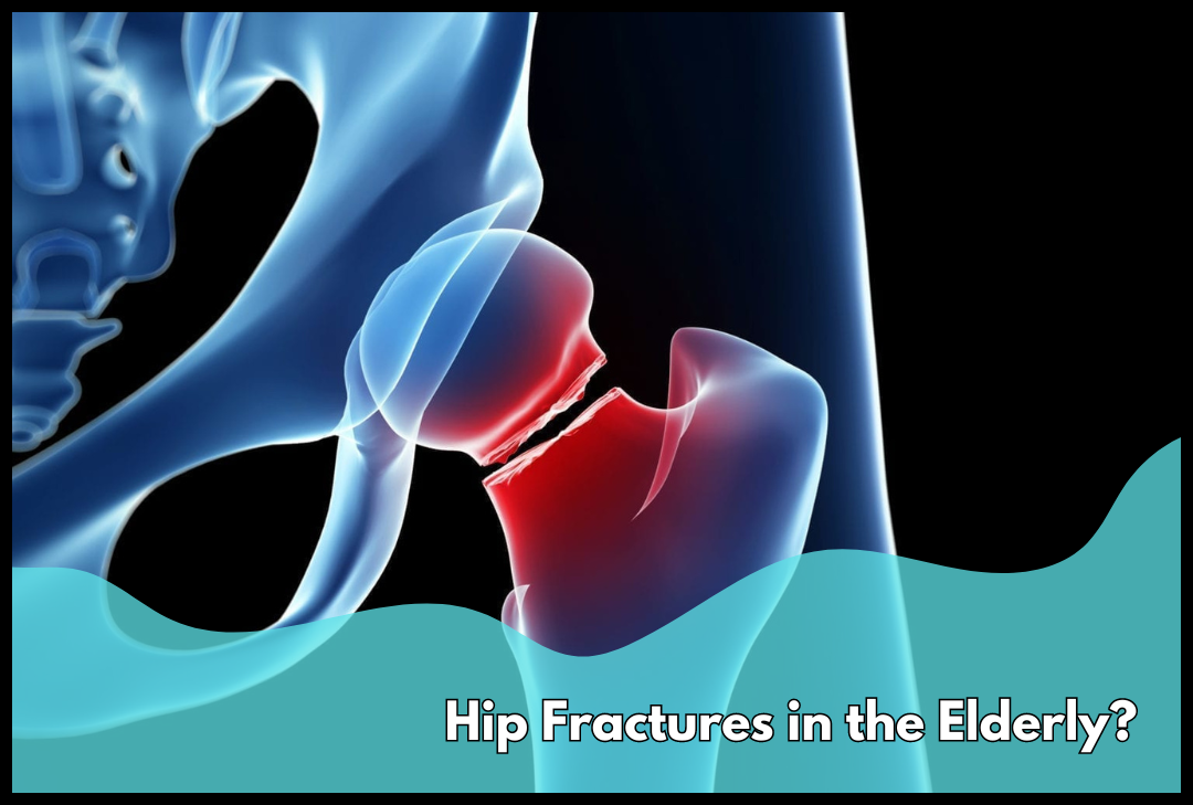 hip fractures in the elderly