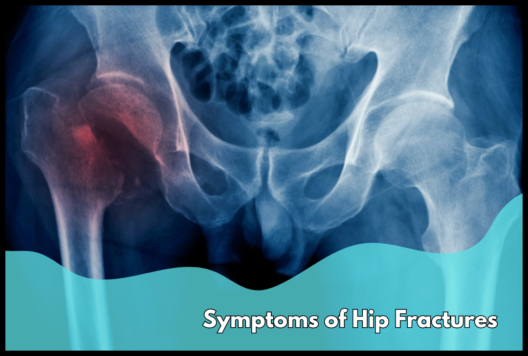 symptoms of hip fractures