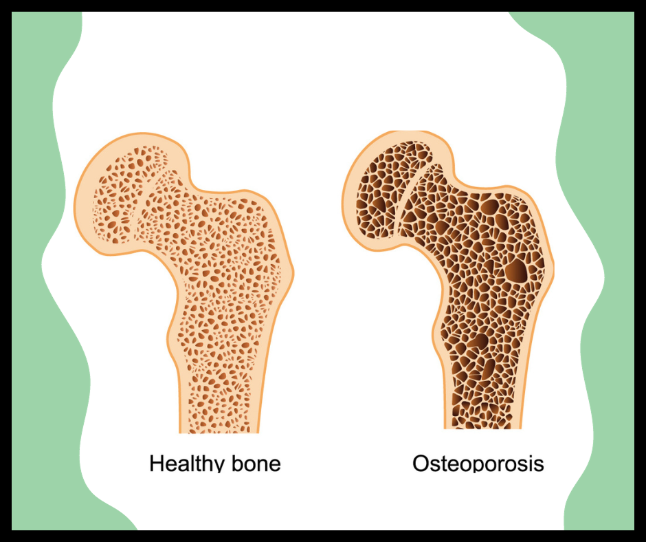what is the cause of osteoporosis, osteoporosis in elderly